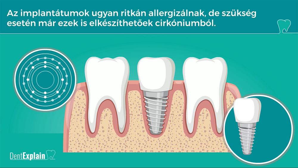 Dent Explain Kulcsrak sz p ciens eduk l rendszer fogorvosoknak